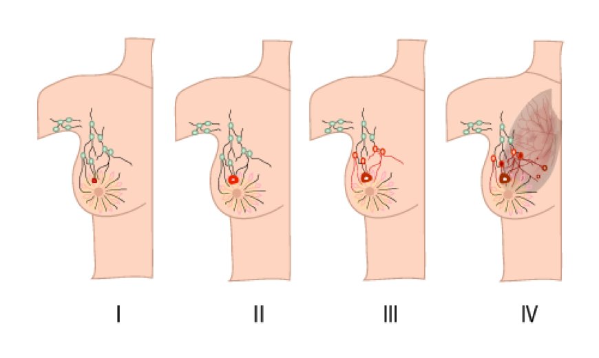 Understanding Stage 1 Breast Cancer: Symptoms and Early Detection