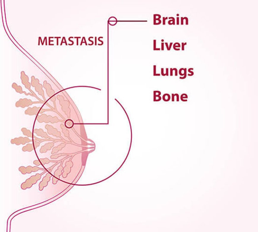 Understanding Early-Stage Breast Cancer